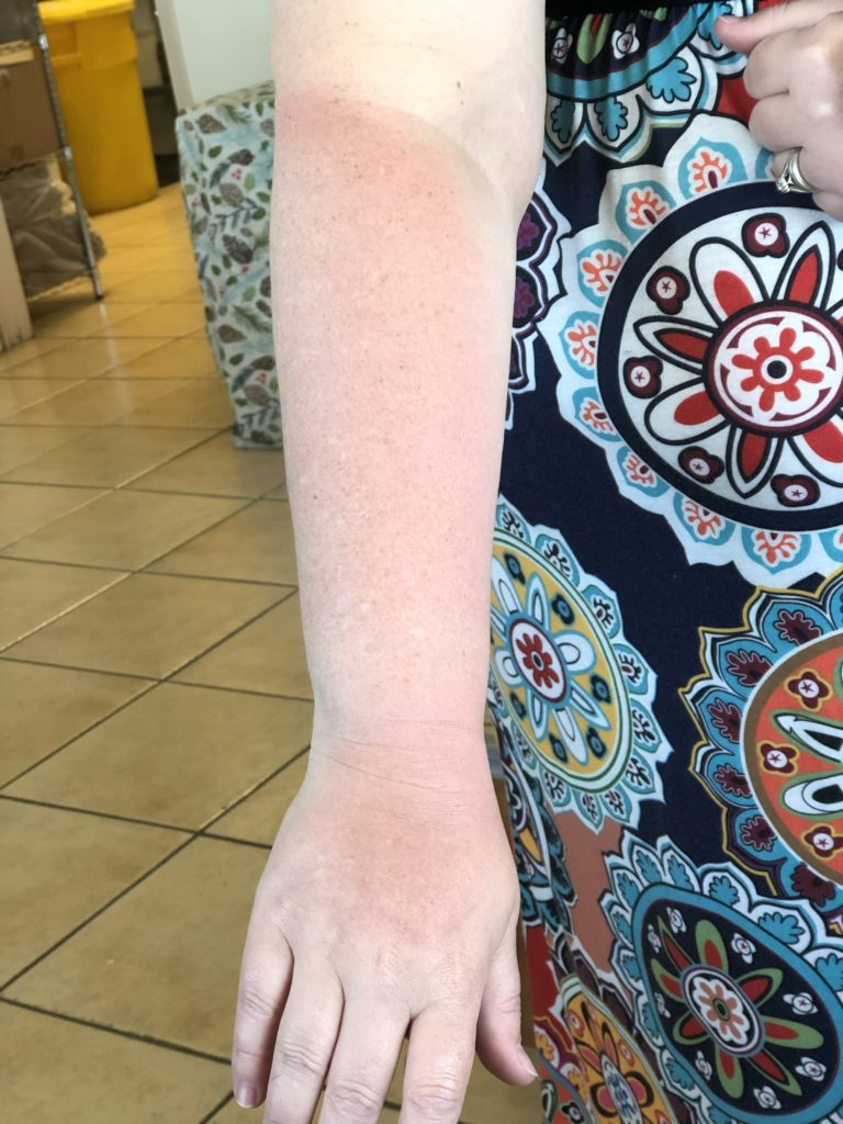 IMG 2629 768x1024 - Activated Charcoal for Sunburns