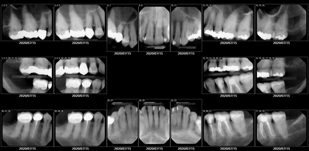 xray image 1 1024x501 - Which Charcoal Powder Should I Use For A Gum Infection, Caused From The Tearing of A Sinus Tube?