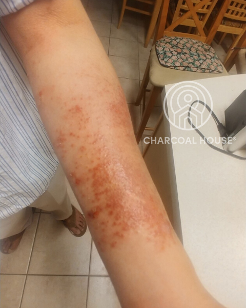 4282020 1am Photo 2 - MD Uses Activated Charcoal For A Nasty Rash
