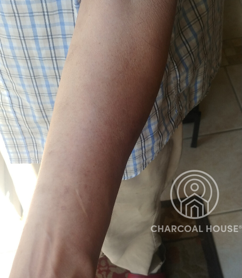 6152020 - MD Uses Activated Charcoal For A Nasty Rash
