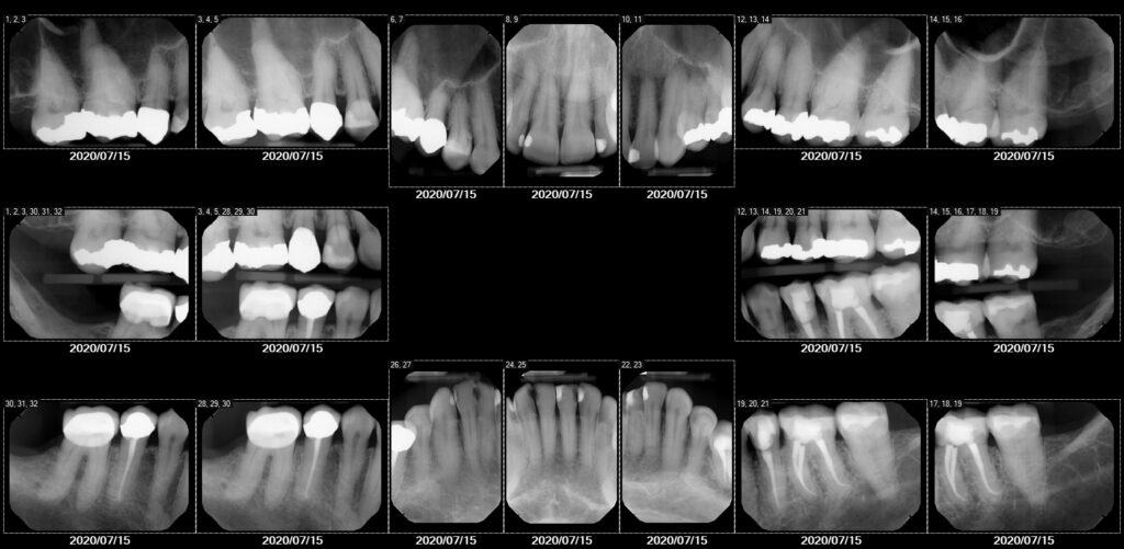 xray image 1024x501 - Activated Charcoal for Root Canal, Jaw Infection